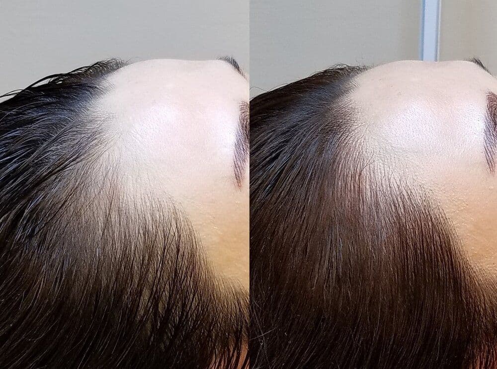 Hairline result 1