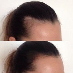 Hairline result 2