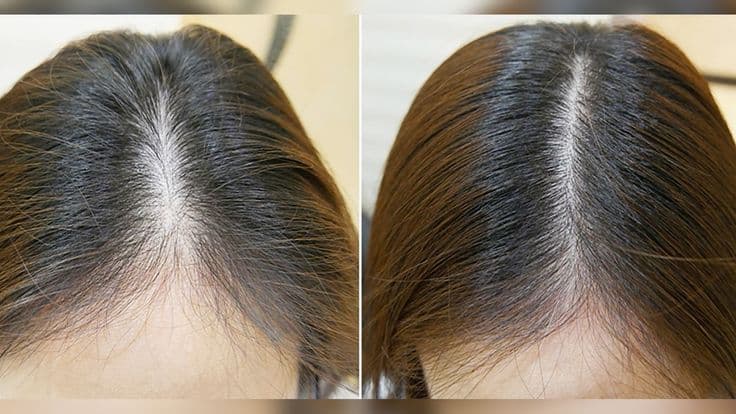 Hairline result 3