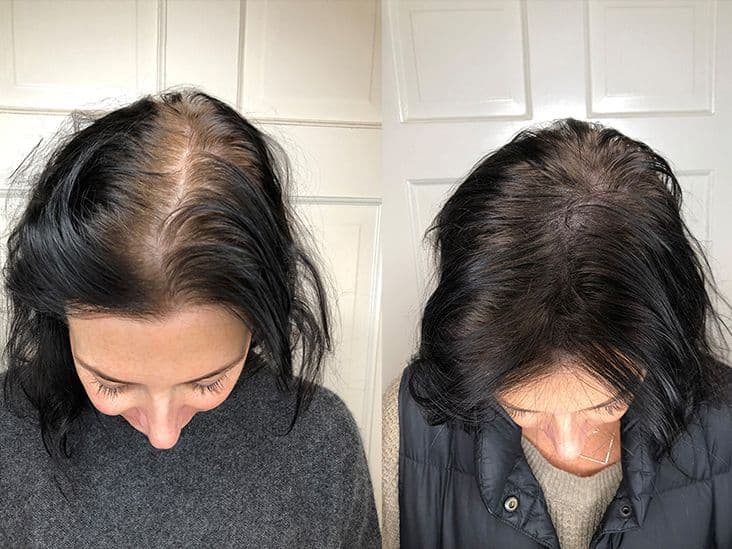 Middle or side part SMP